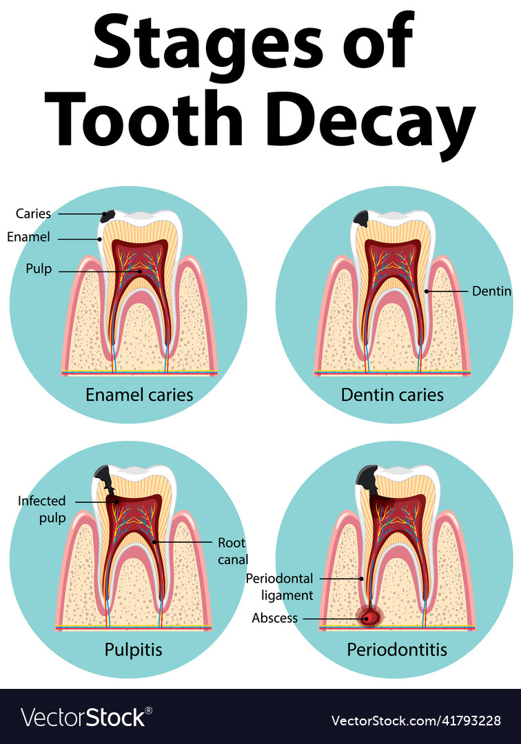 Infographic of human in the stages of tooth decay Vector Image