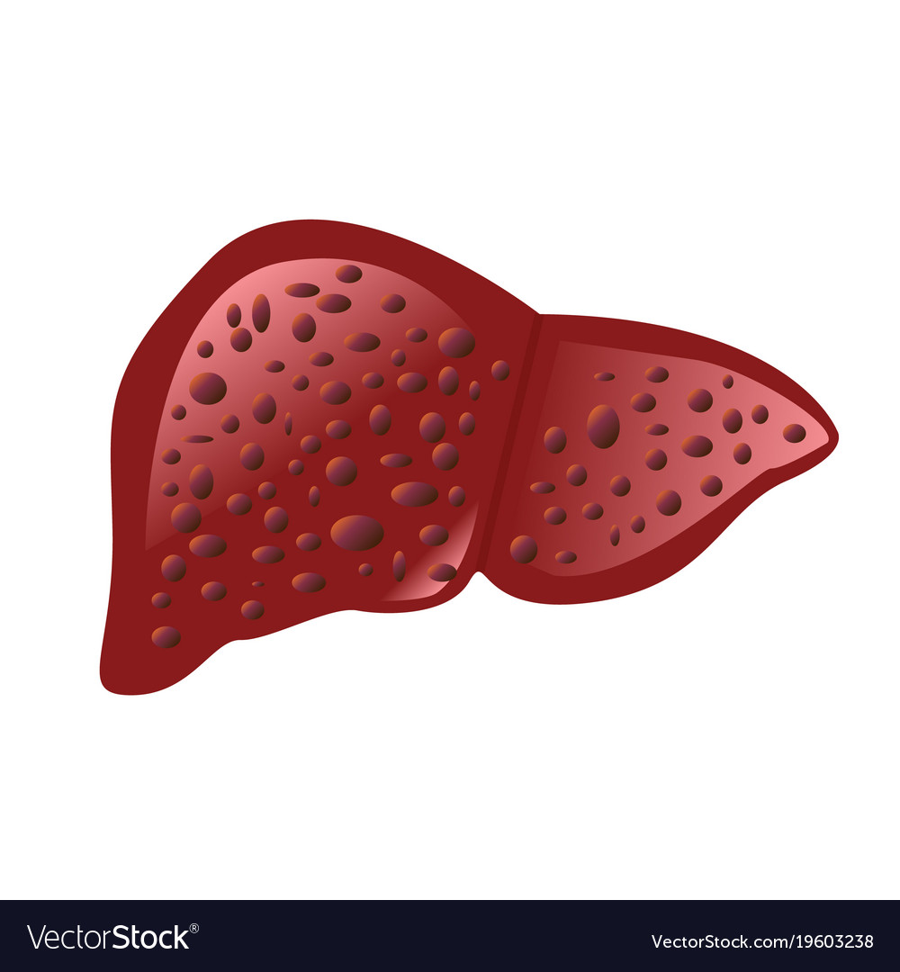 Liver affected by cirrhosis