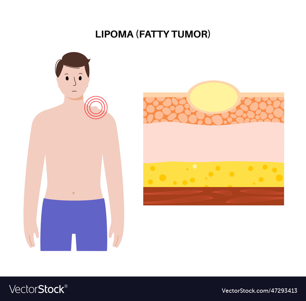 Lipoma medical poster Royalty Free Vector Image