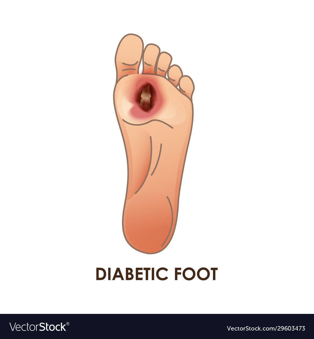 Diabetic foot defeat ulcer skin sores Royalty Free Vector