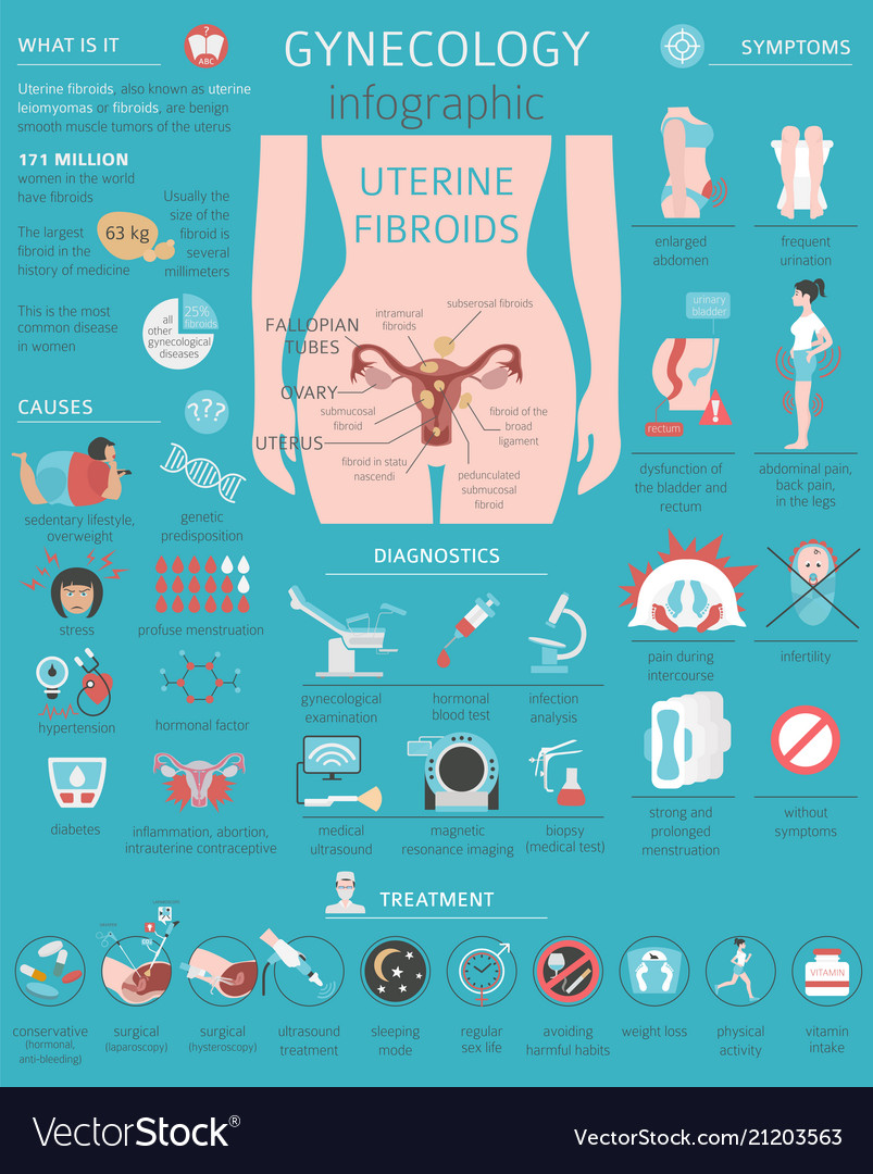 Uterine Fibroids Ginecological Medical Desease In Vector Image