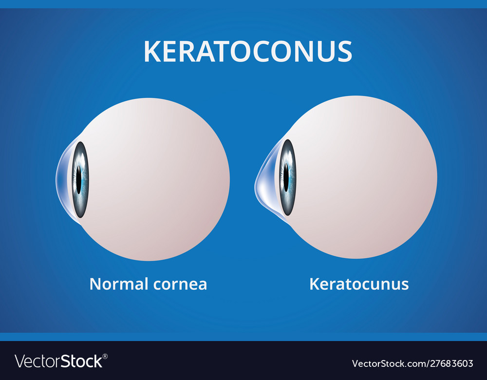 Eye cornea and keratoconus disorder medical