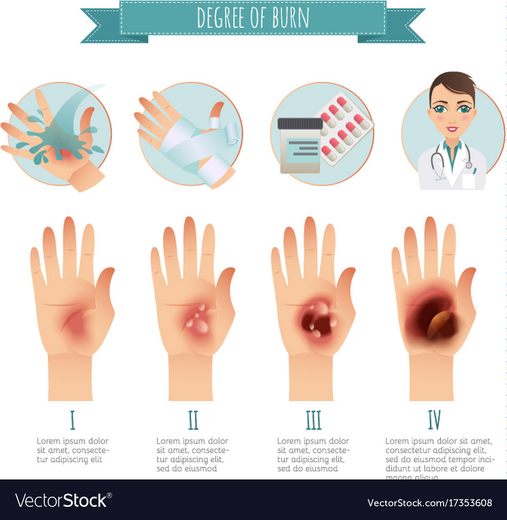 Burns treatment degree skin burns Royalty Free Vector Image