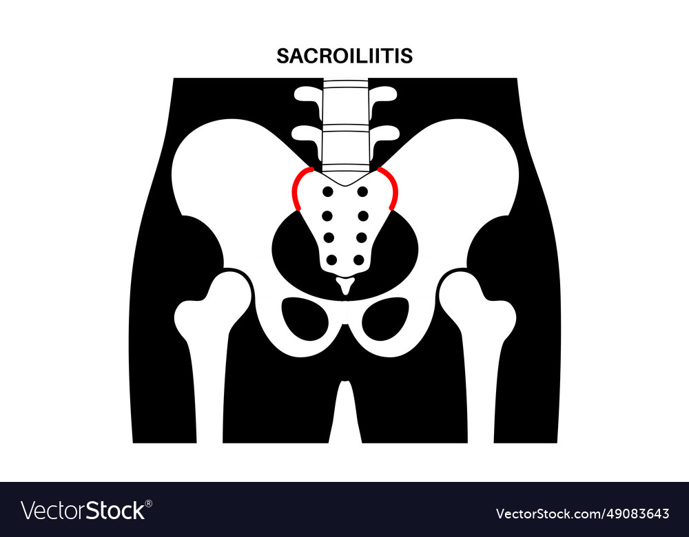 Sacroiliitis medical poster