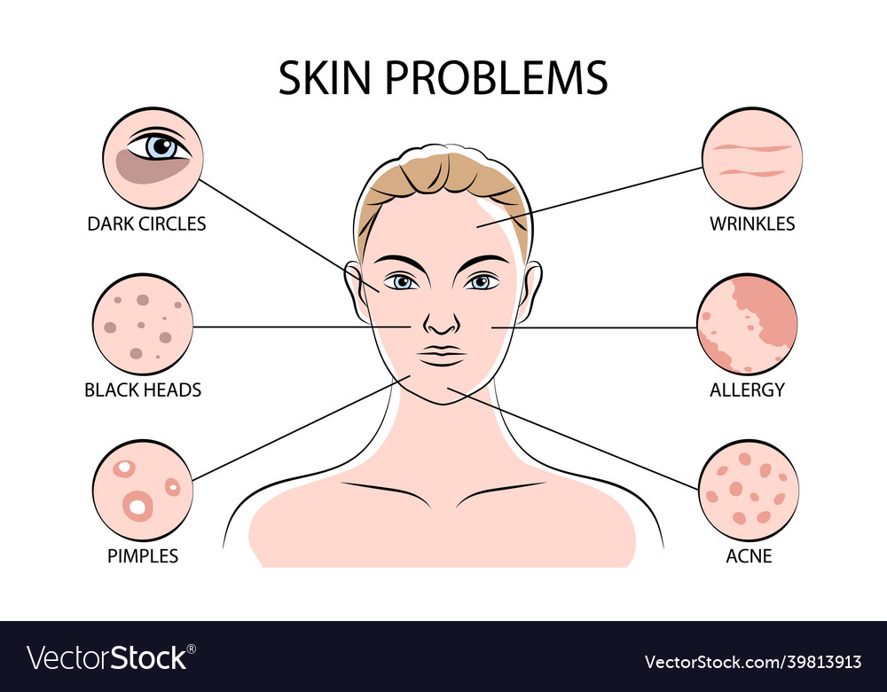 Skin problems infographics Royalty Free Vector Image