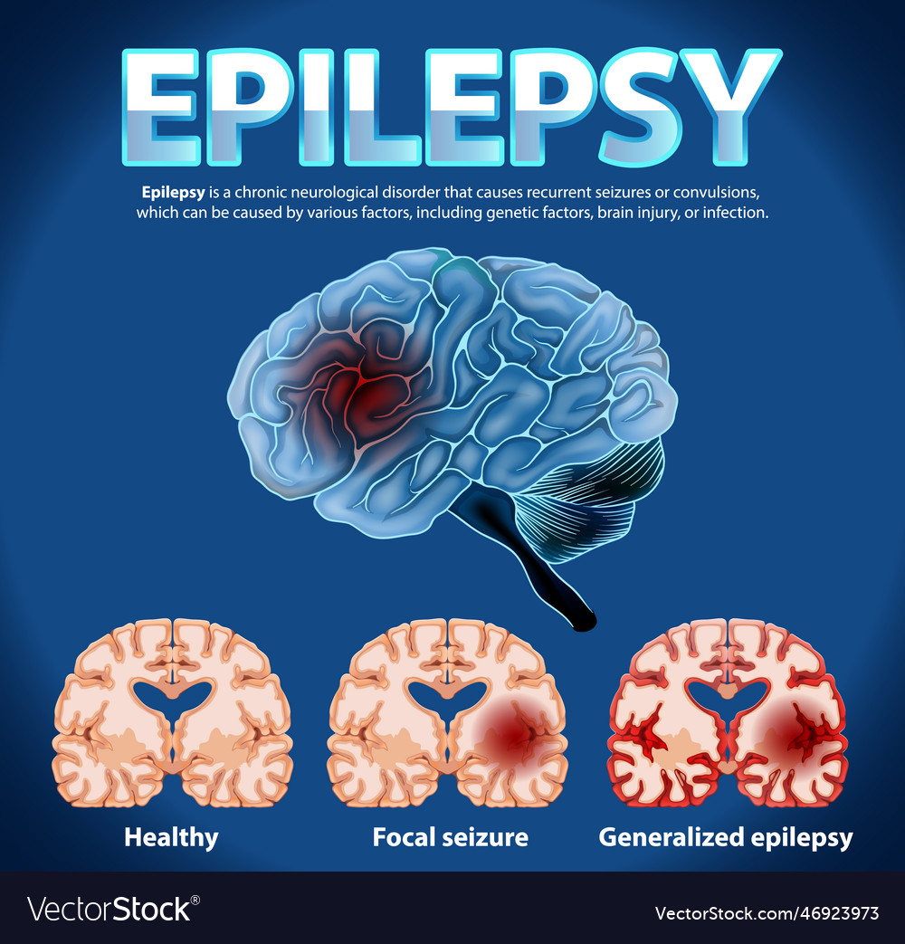 Informative poster of epilepsy Royalty Free Vector Image