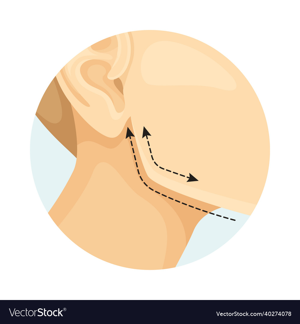 Cheekbone correction cosmetic surgery procedure