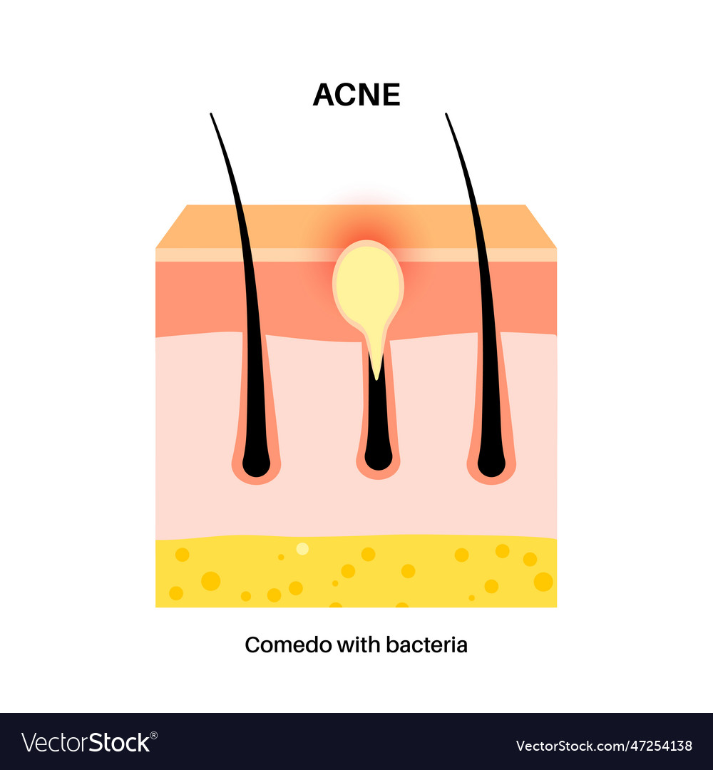 Acne treatment poster Royalty Free Vector Image