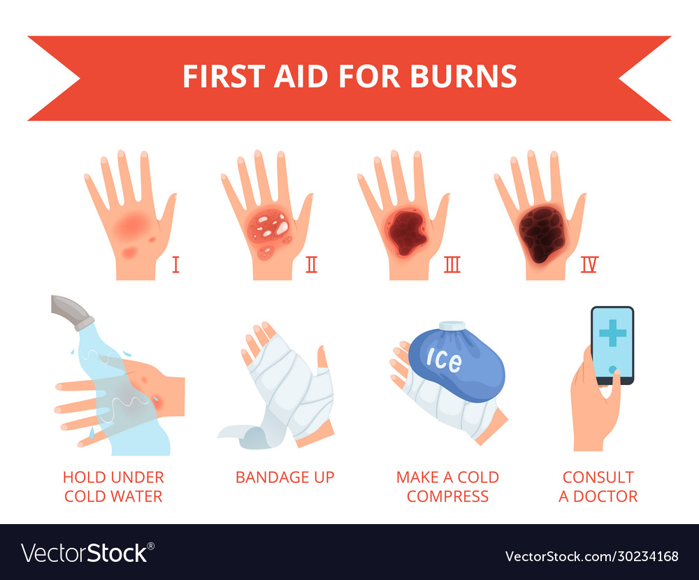 Burn skin first treatment human hand fire or Vector Image