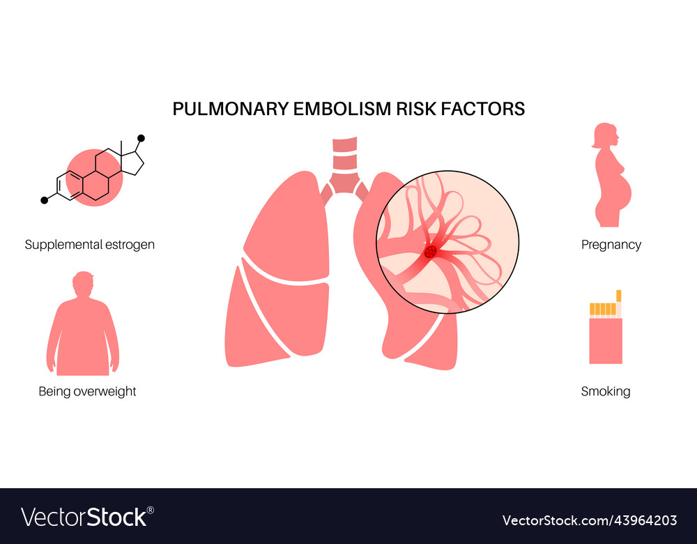 Pulmonary Embolism Disease Royalty Free Vector Image