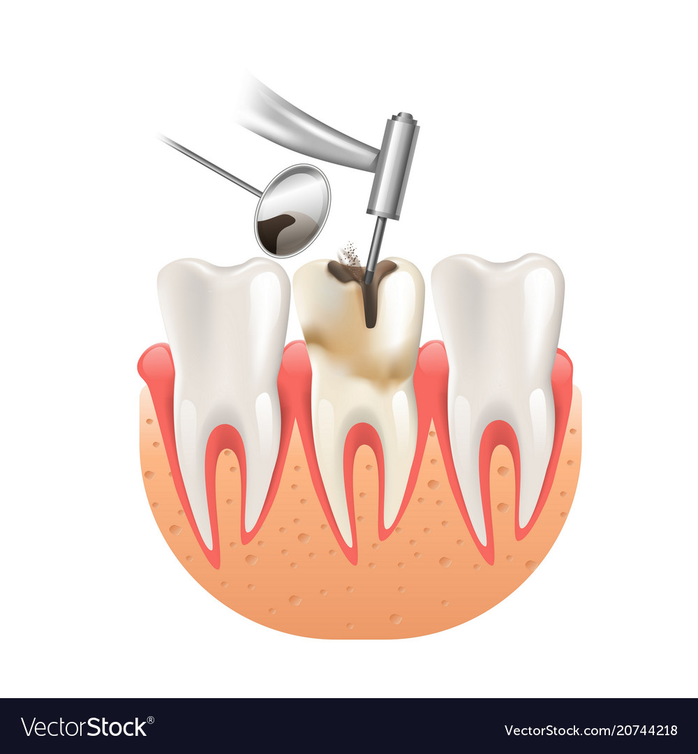 clean caries by tooth dental drill 3d realistic vector image