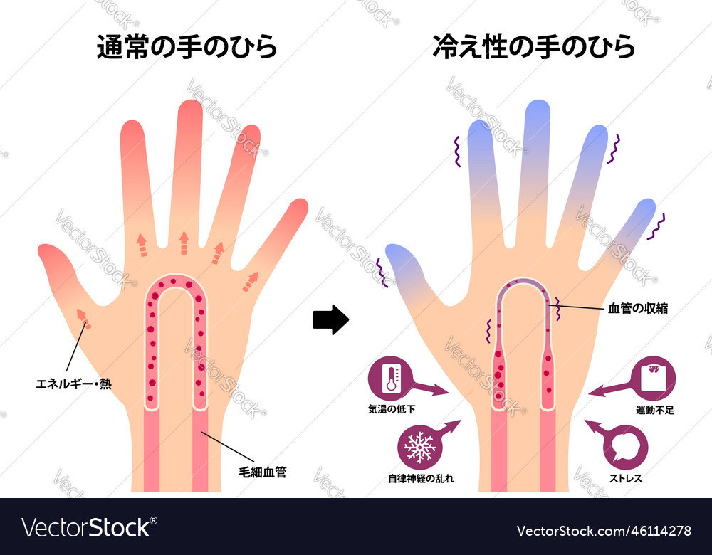 Comparison of normal hand and cold