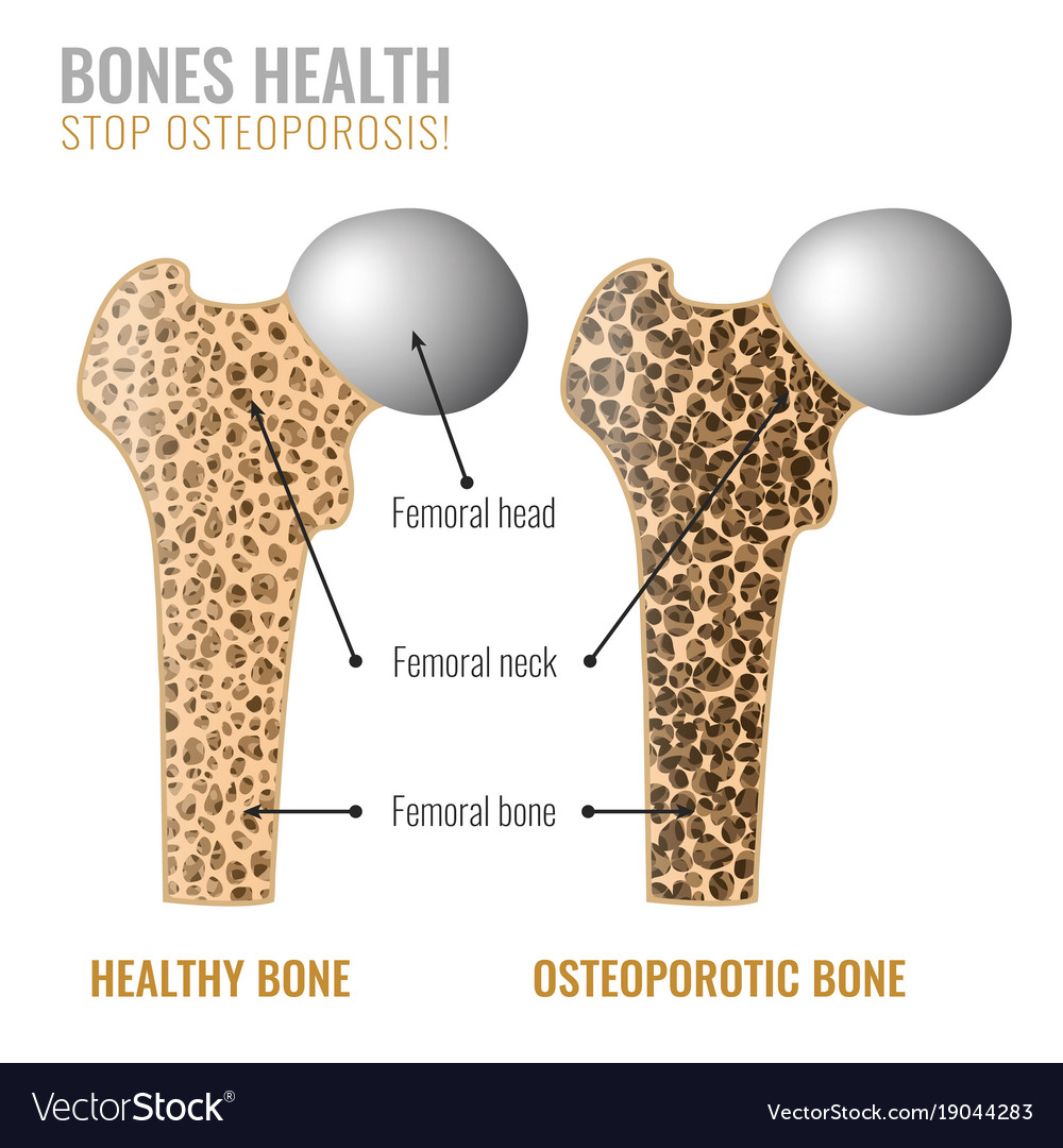 Osteoporosis bone image Royalty Free Vector Image