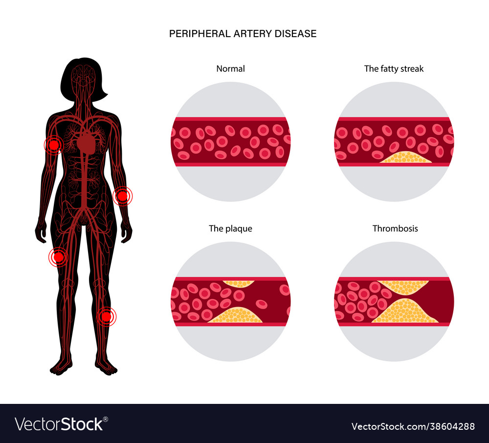 Peripheral artery disease