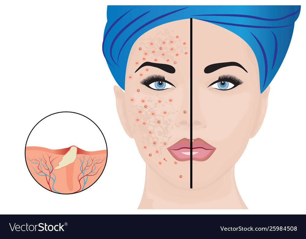 Acne Pustules On A Woman Face And Treatment Result