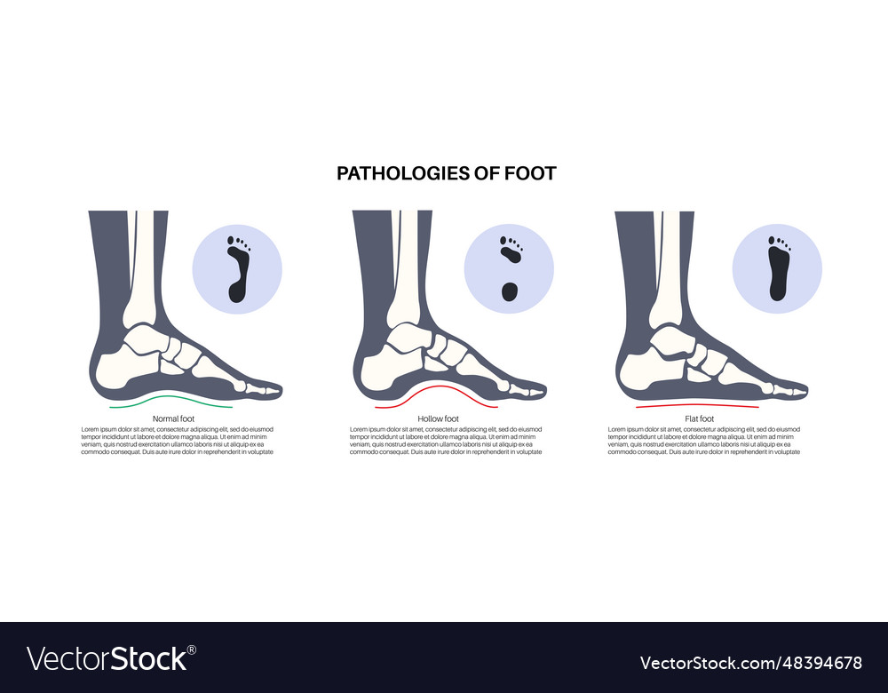 Foot pathologies poster Royalty Free Vector Image