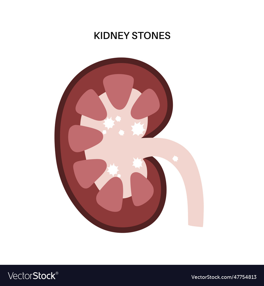 Kidney stones treatment Royalty Free Vector Image