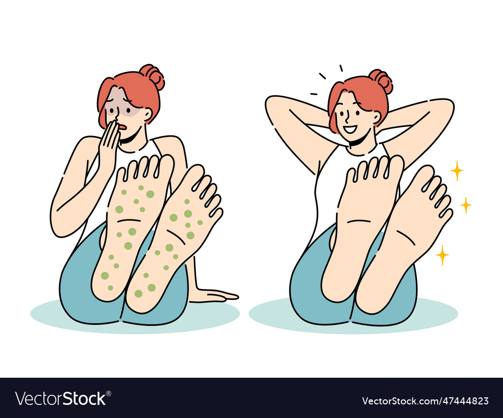 Woman with rash on feet suffers from allergies Vector Image