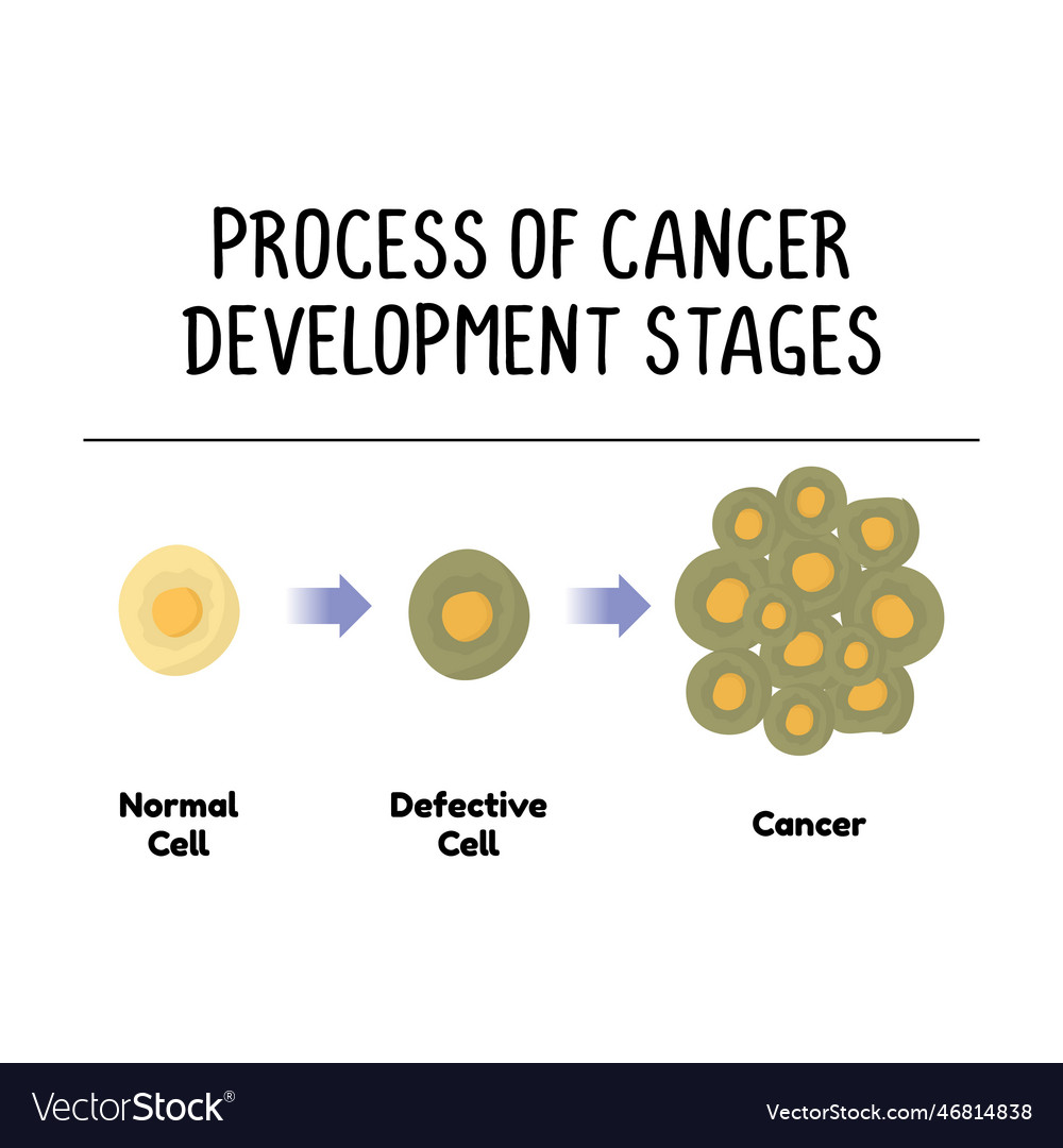 Process Of Cancer Development Stages Isolated On Vector Image