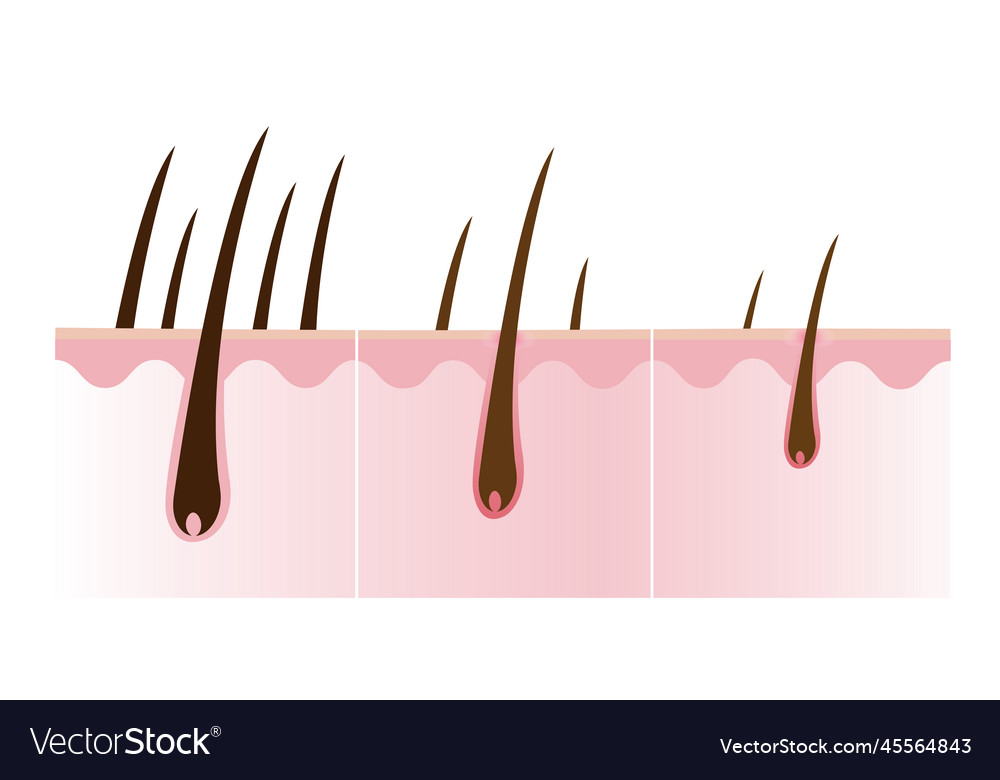 Step of hair loss Royalty Free Vector Image - VectorStock