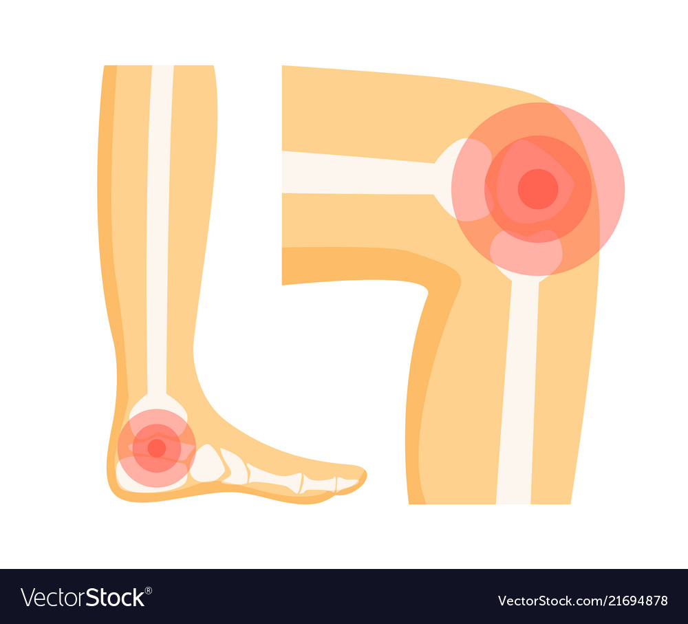 Orthopedic problems in foot Royalty Free Vector Image