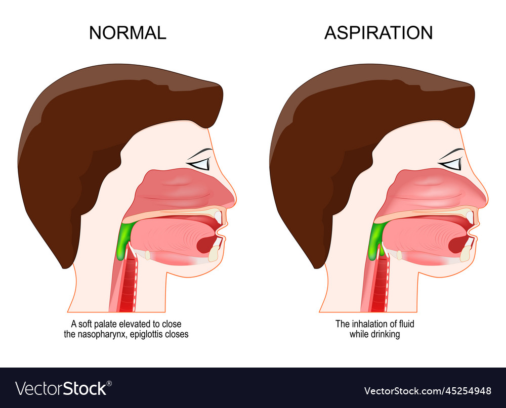 dysphagia-or-aspiration-medical-diagnosis-vector-image