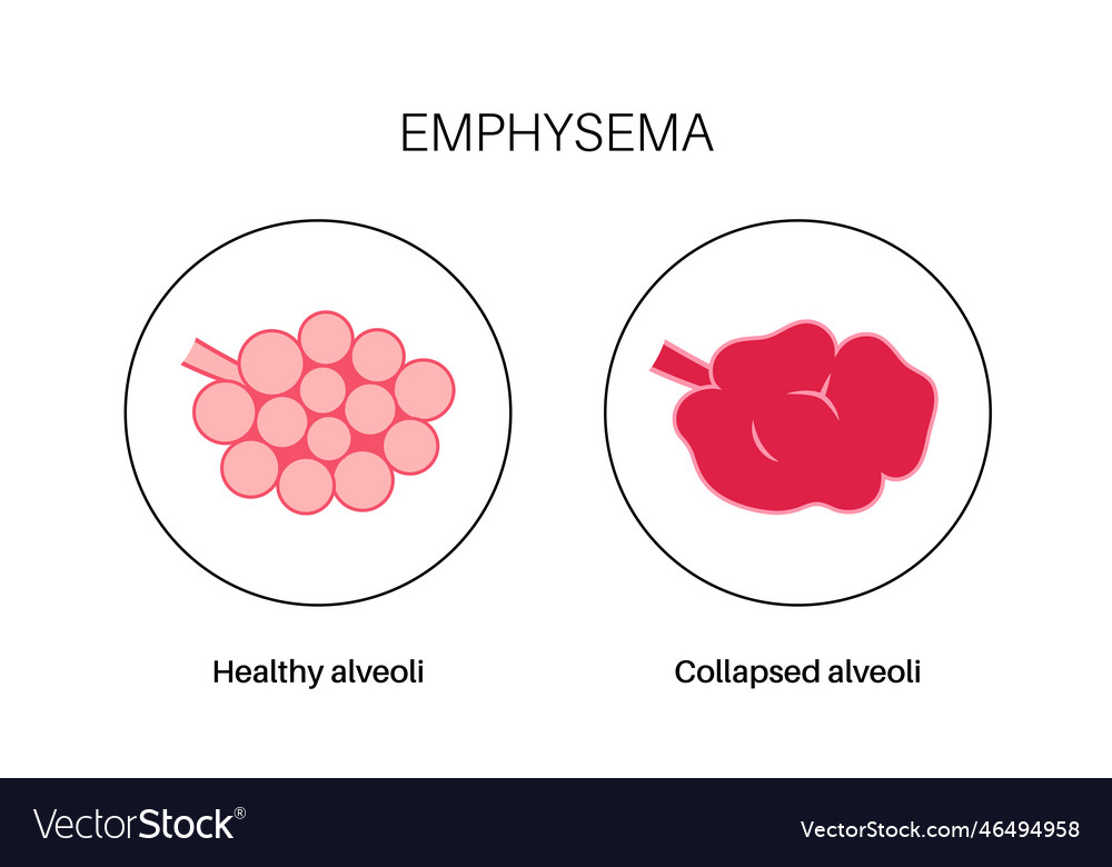 Emphysema anatomical poster