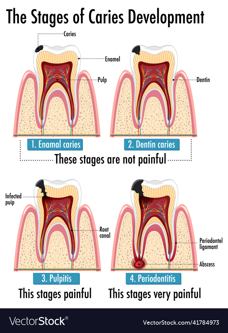 Infographic of human in stages of caries Vector Image