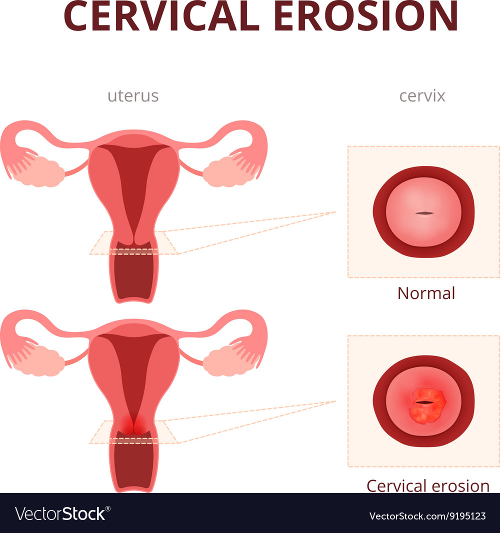 Cervical Erosion Schematic Royalty Free Vector Image