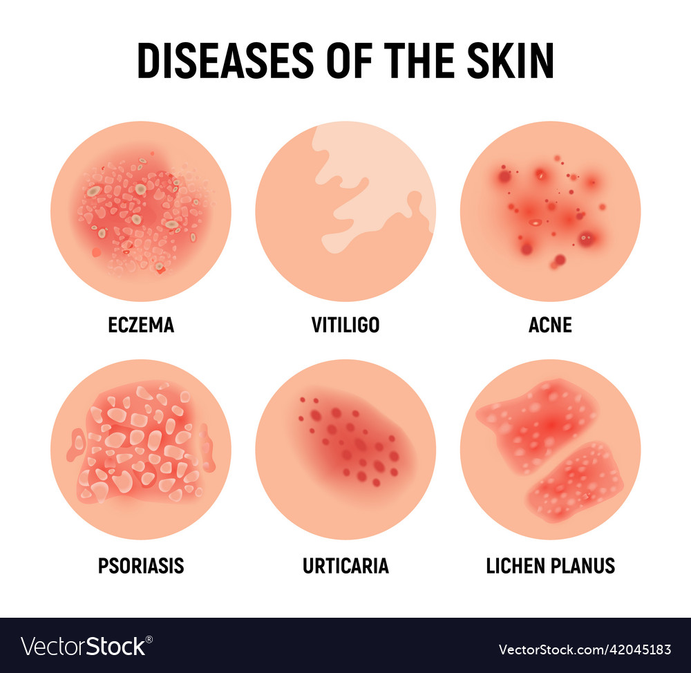 Psoriasis rash skin hand infection Royalty Free Vector Image