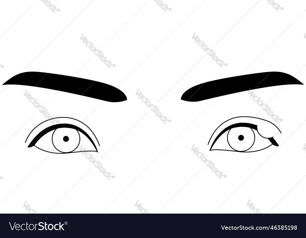 Medical clipart line drawing of eye disease Vector Image