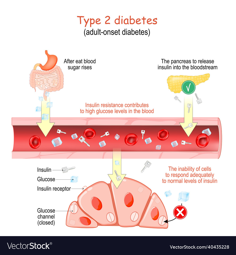 Type 2 diabetes adult-onset diabetes Royalty Free Vector