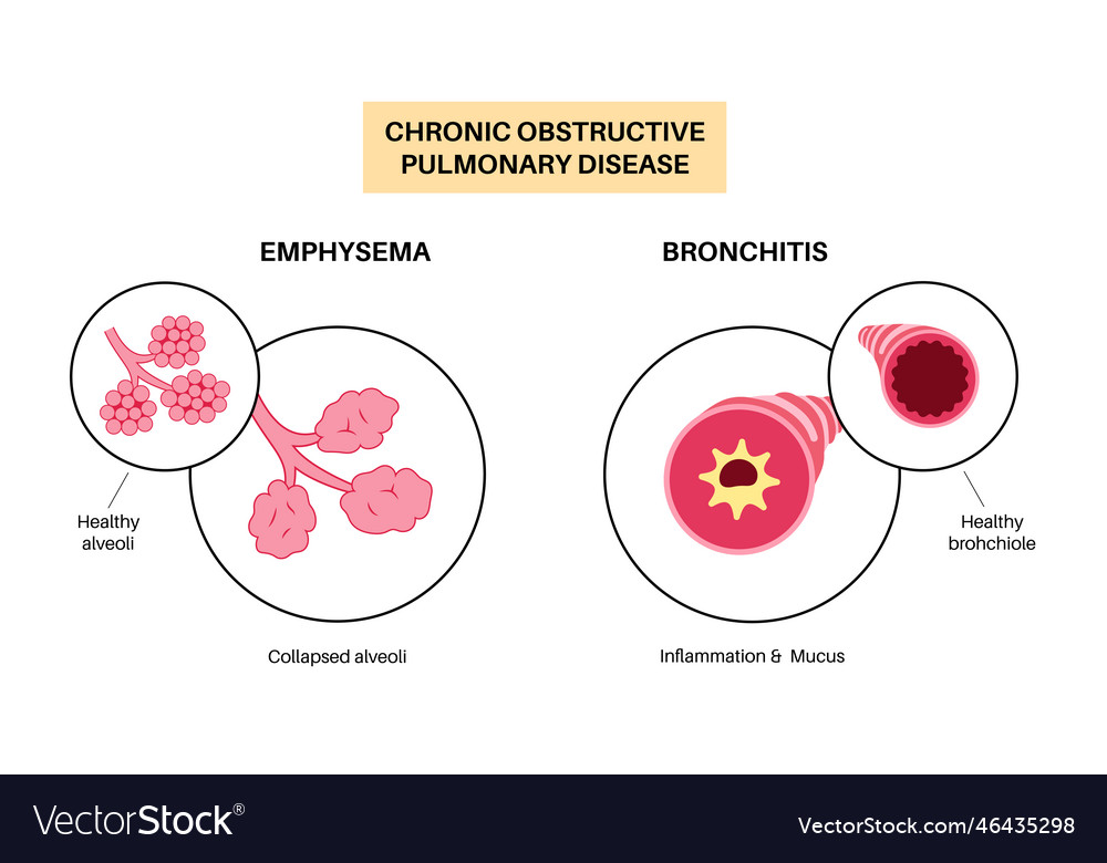 Chronic obstructive pulmonary disease Royalty Free Vector