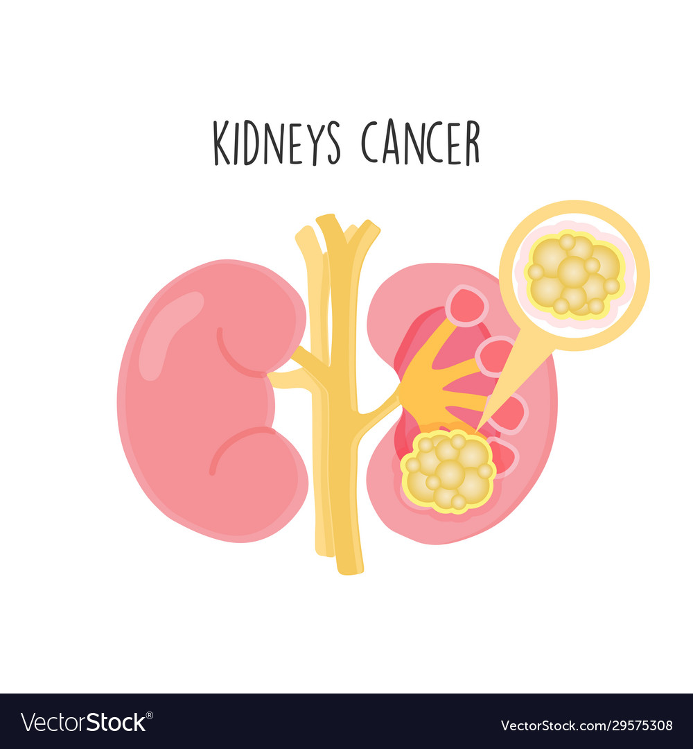 Kidney Cancer Flat Royalty Free Vector Image Vectorstock Kidney Cancer Flat Royalty Free Vector Image Vectorstock