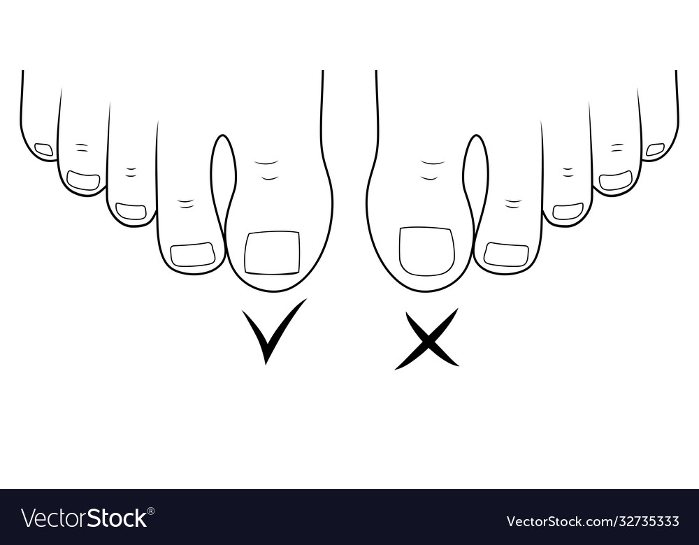 Right To Cut Toenails Ingrown Toe Nail Royalty Free Vector Right To Cut Toenails Ingrown Toe Nail Royalty Free Vector