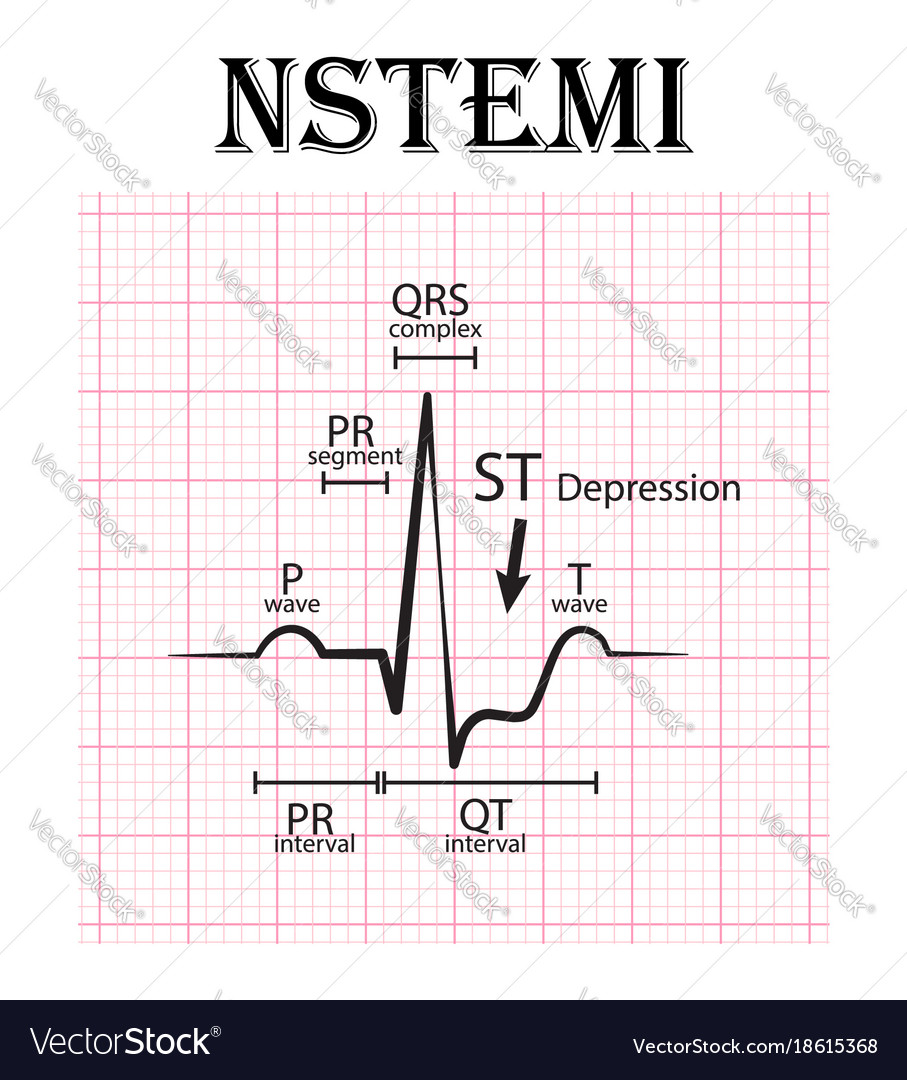 Ecg of non st elevation myocardial infarction Vector Image