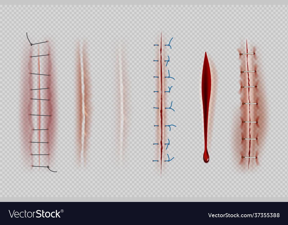 Surgical sutures medical closeup stitches scars Vector Image