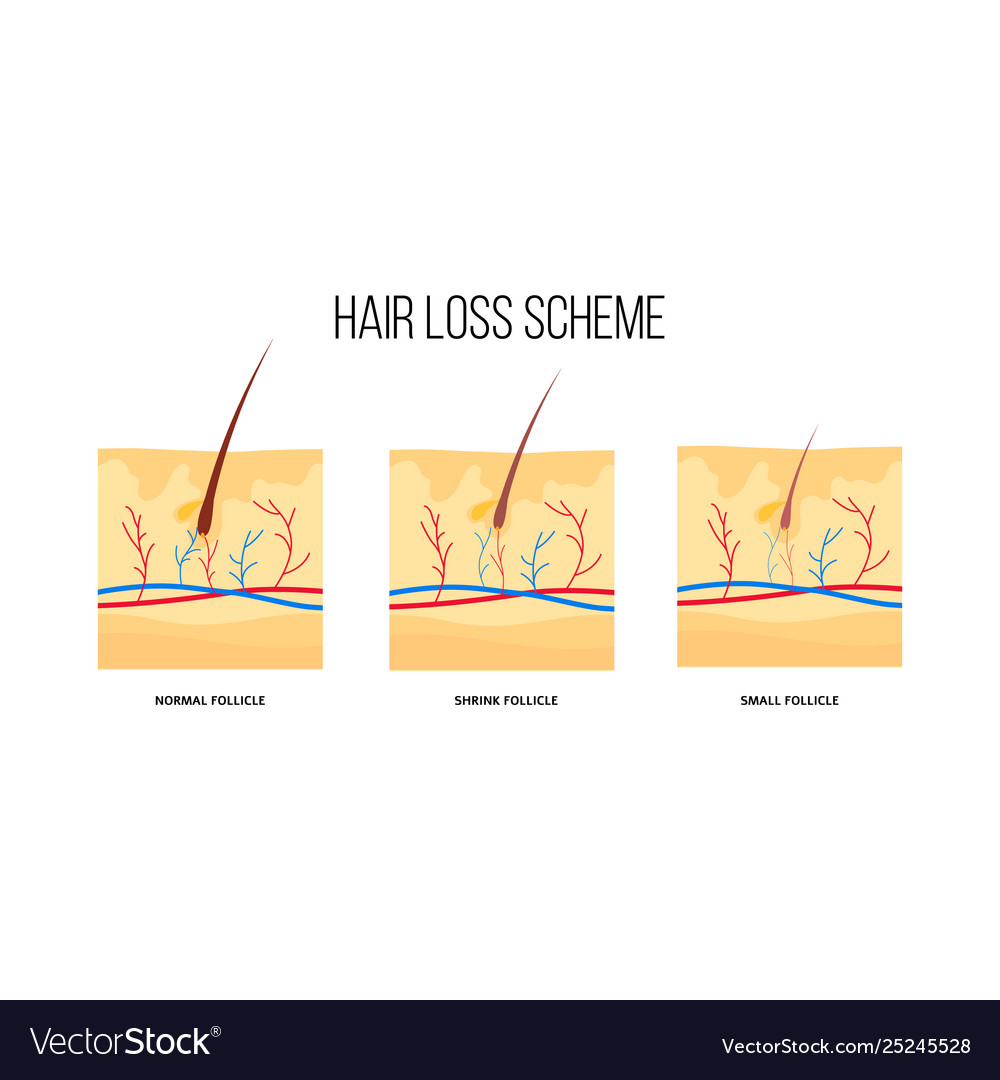 Human hair loss scheme flat style Royalty Free Vector Image Human hair loss scheme flat style Royalty Free Vector Image