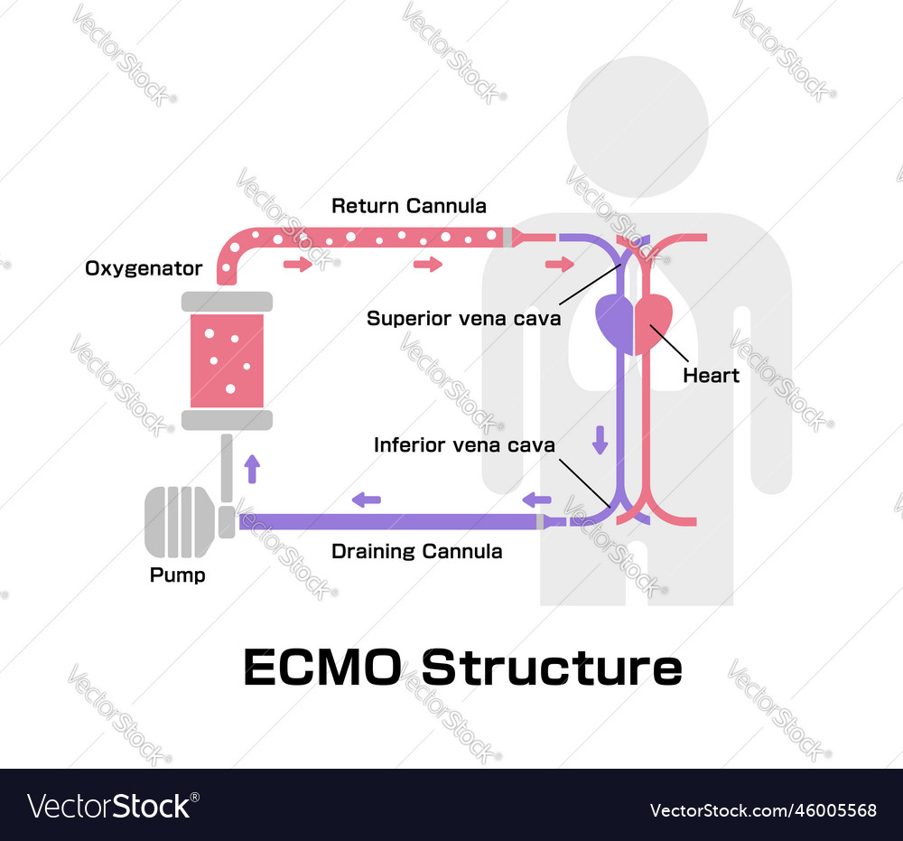 Ecmo extracorporeal membrane oxygenation Vector Image