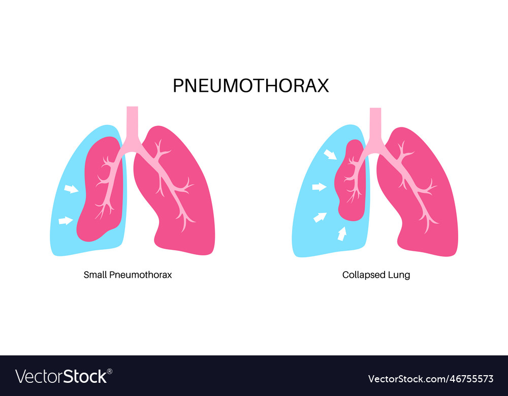 Pneumothorax anatomical poster Royalty Free Vector Image