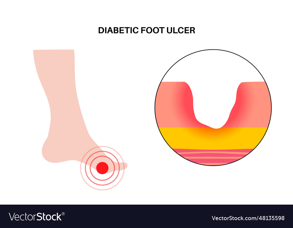 Diabetic foot ulcers