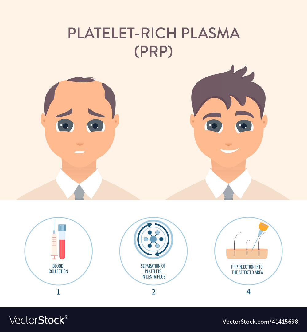 Prp Hair Loss Treatment Procedure Medical Poster Vector Image Prp Hair Loss Treatment Procedure Medical Poster Vector Image
