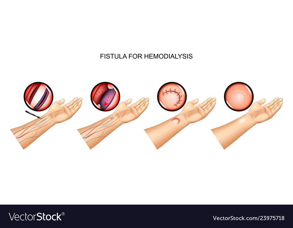 Fistula for hemodialysis suturing of vein Vector Image