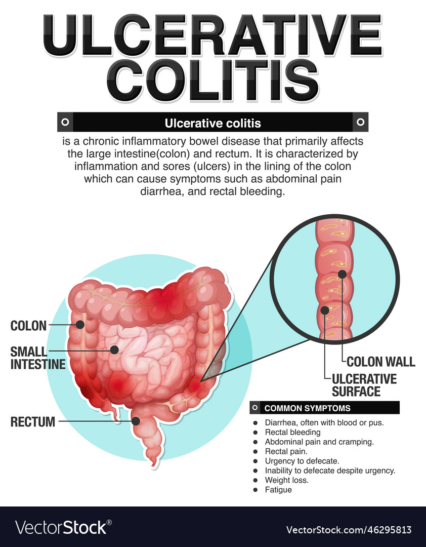 Ulcerative colitis symptoms infographic Royalty Free Vector