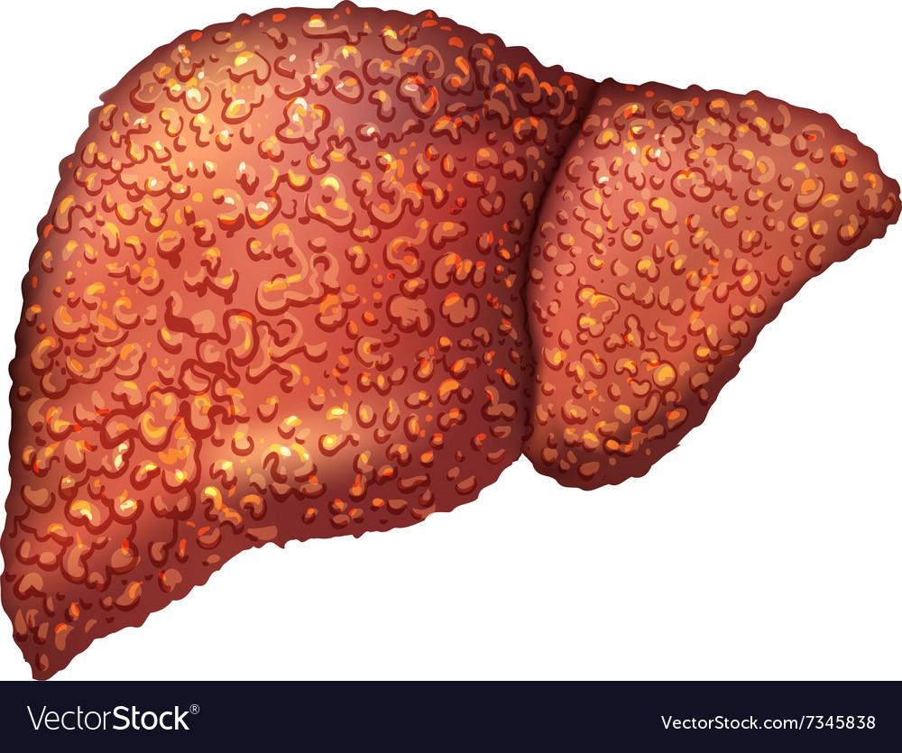 Liver patients with hepatitis is sick