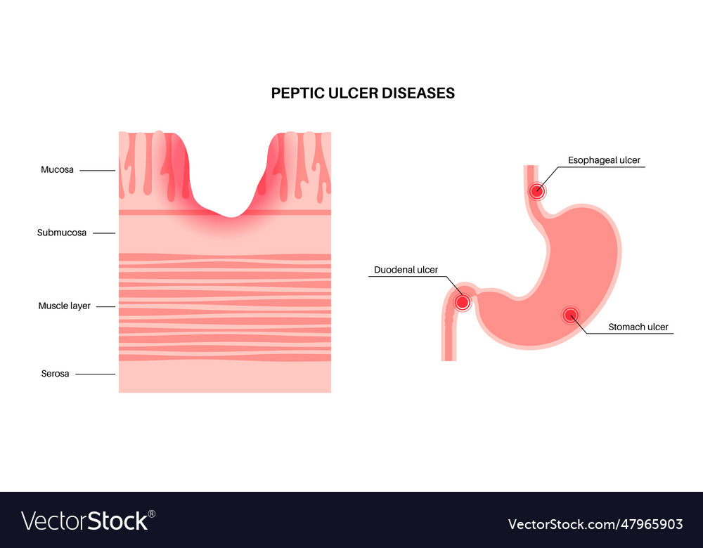 Peptic ulcer disease