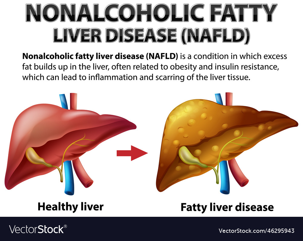 Nonalcoholic fatty liver disease Royalty Free Vector Image