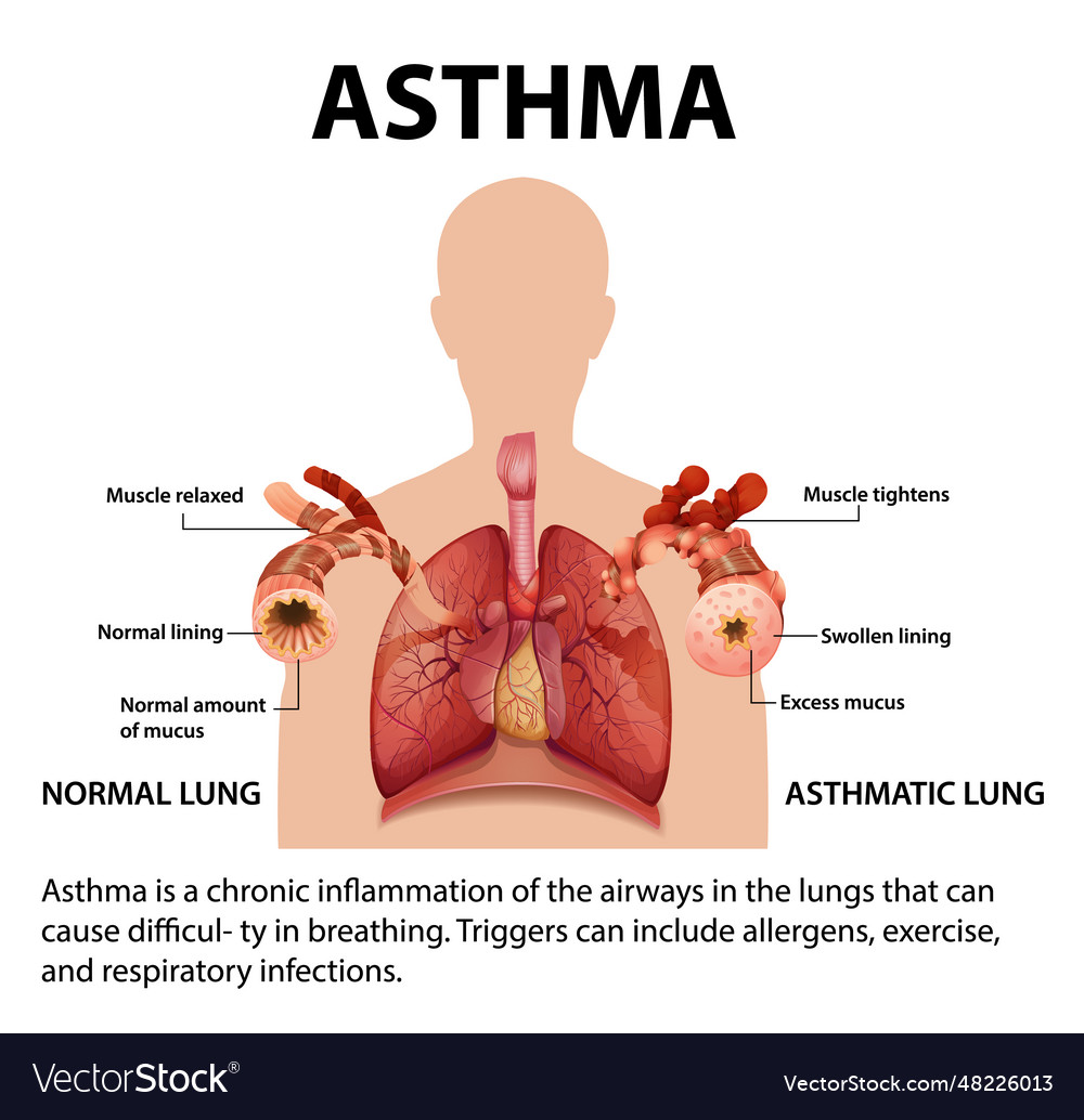 Comparing normal and asthma lungs an educational Vector Image