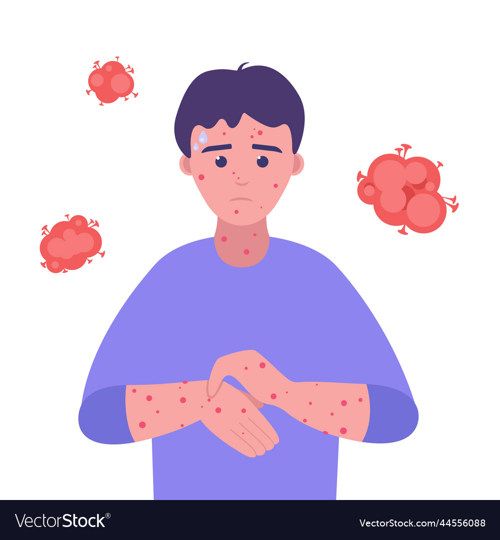 Man sick with monkeypox virus in flat style Vector Image