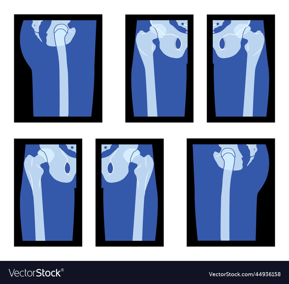 Set of x-ray hip and leg head the femur